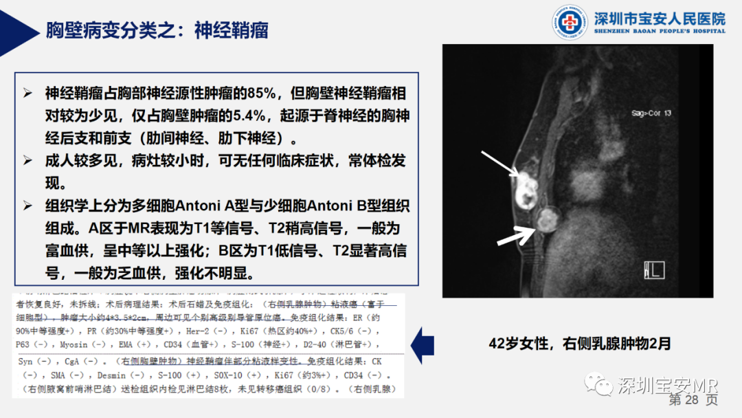 影像PPT - 【PPT】胸壁病变的影像诊断-28