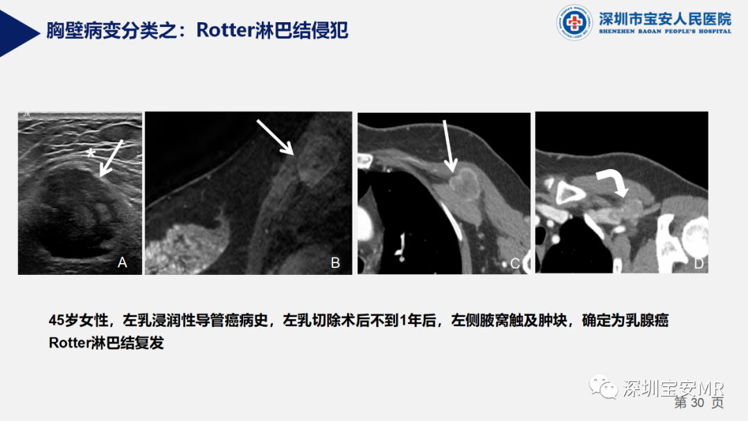 影像PPT - 【PPT】胸壁病变的影像诊断-30