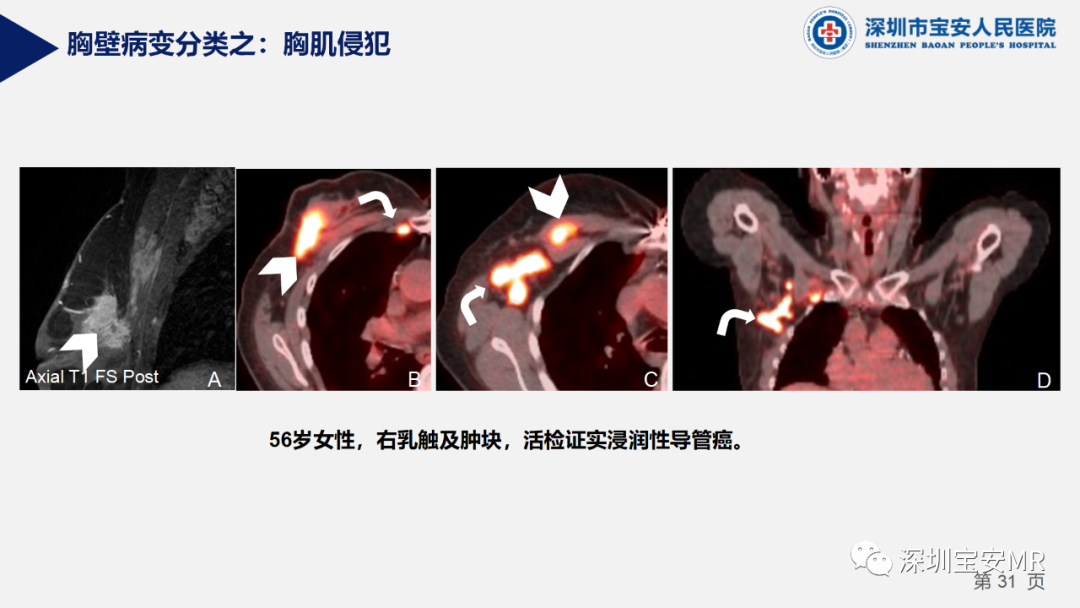 影像PPT - 【PPT】胸壁病变的影像诊断-31