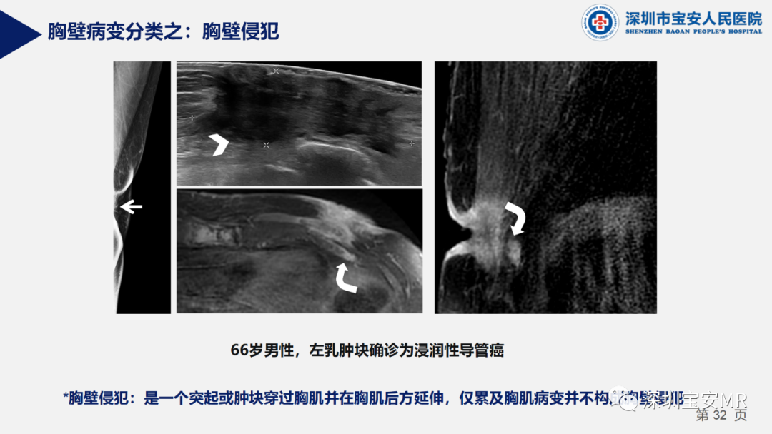 影像PPT - 【PPT】胸壁病变的影像诊断-32