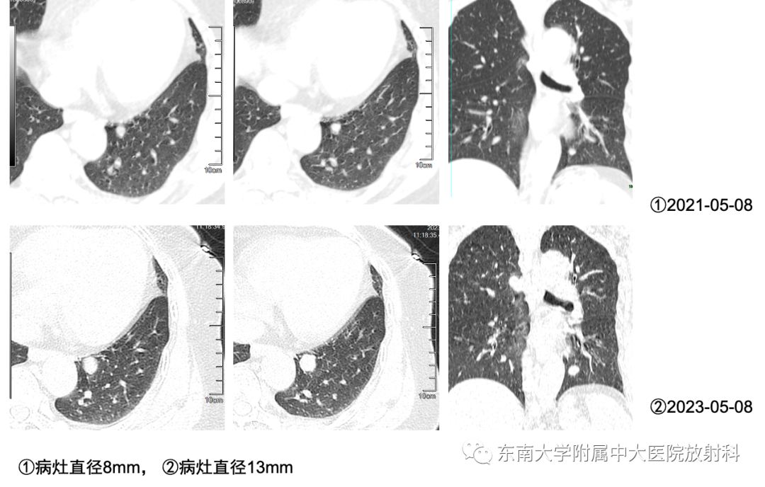 影像PPT - 【PPT】肺硬化性肺细胞瘤-1