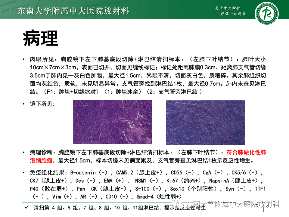 影像PPT - 【PPT】肺硬化性肺细胞瘤-3