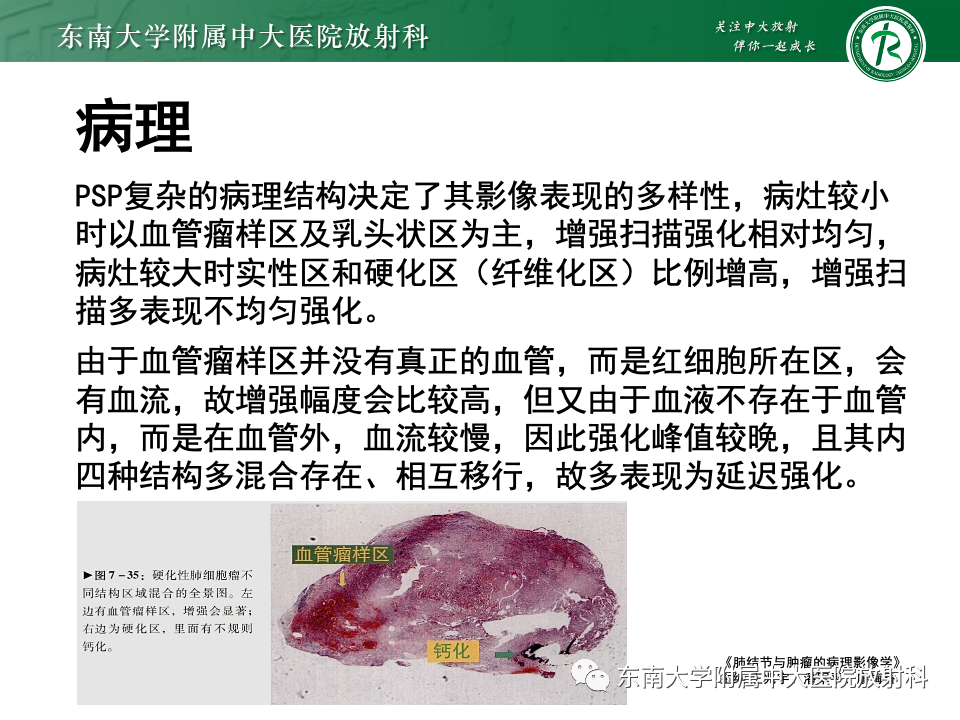 影像PPT - 【PPT】肺硬化性肺细胞瘤-8