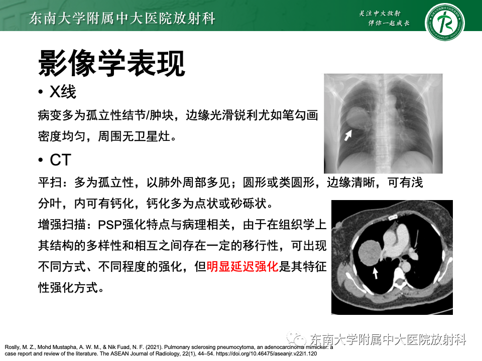 影像PPT - 【PPT】肺硬化性肺细胞瘤-9