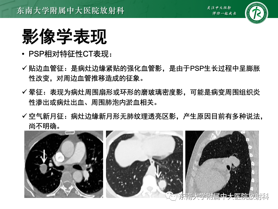 影像PPT - 【PPT】肺硬化性肺细胞瘤-10