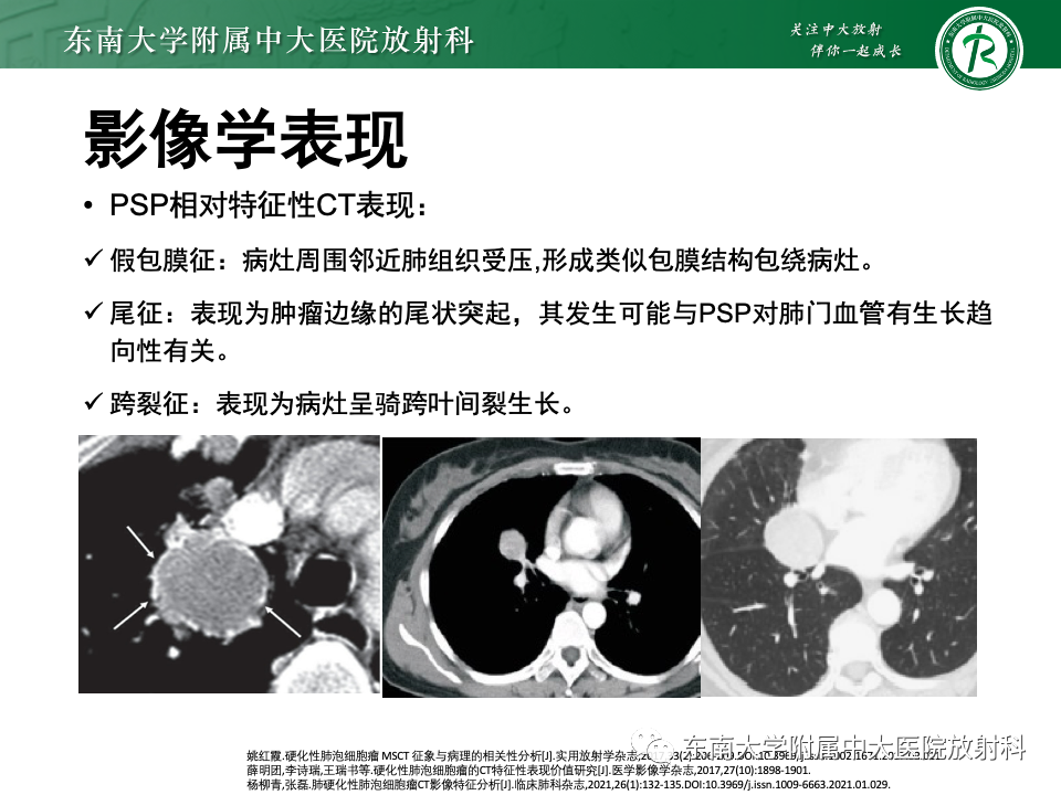 影像PPT - 【PPT】肺硬化性肺细胞瘤-11