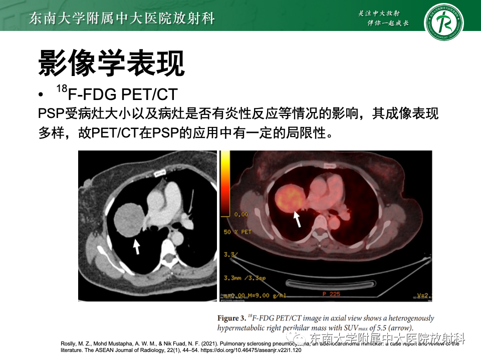 影像PPT - 【PPT】肺硬化性肺细胞瘤-12