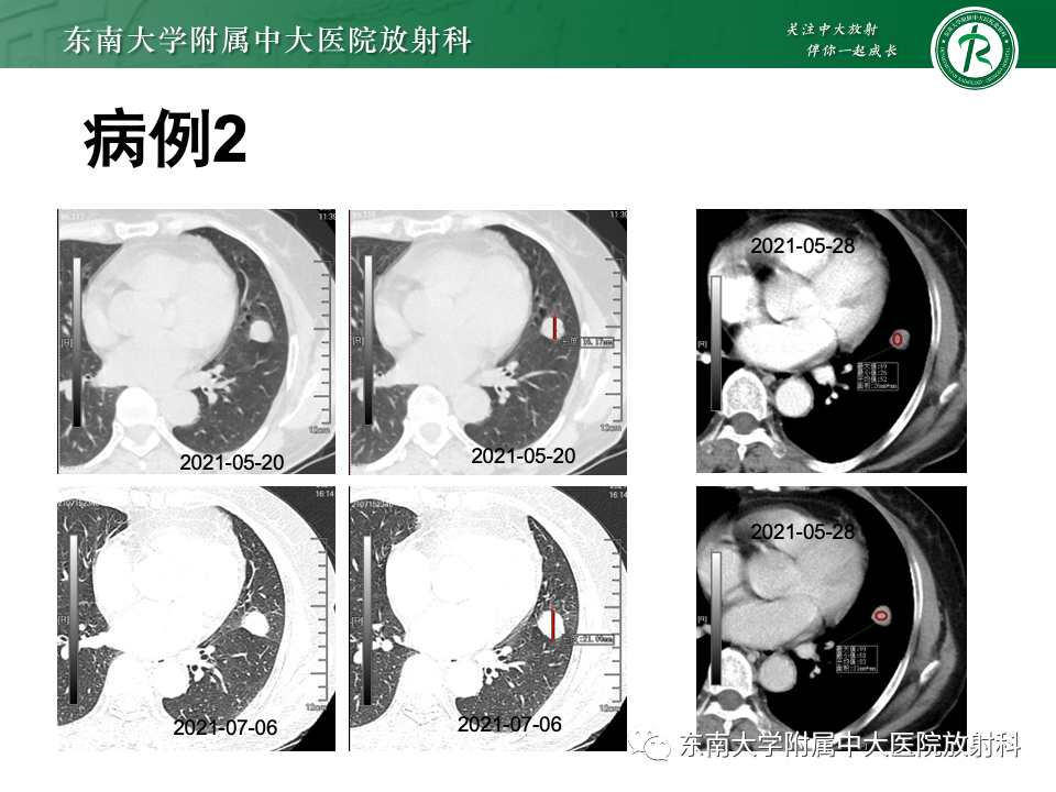 影像PPT - 【PPT】肺硬化性肺细胞瘤-14