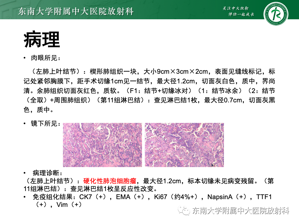影像PPT - 【PPT】肺硬化性肺细胞瘤-15