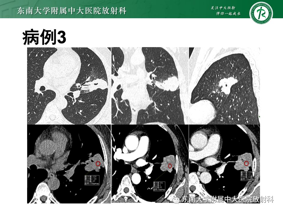 影像PPT - 【PPT】肺硬化性肺细胞瘤-19