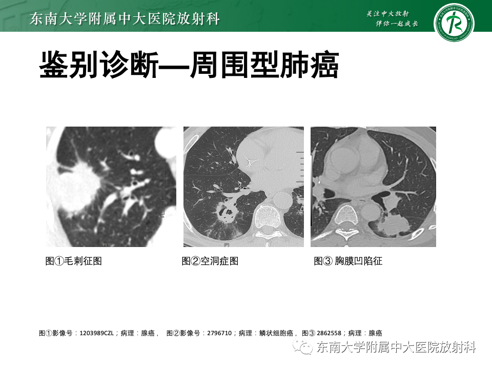 影像PPT - 【PPT】肺硬化性肺细胞瘤-21