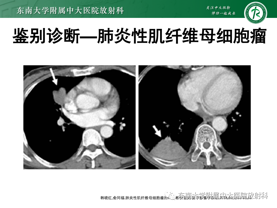 影像PPT - 【PPT】肺硬化性肺细胞瘤-23