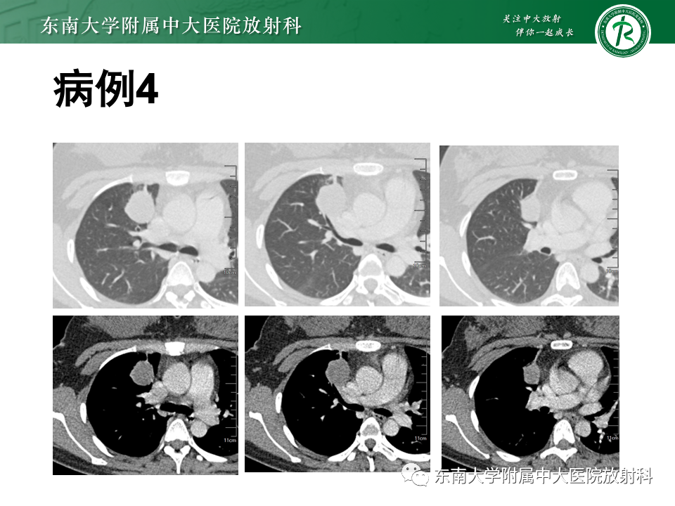 影像PPT - 【PPT】肺硬化性肺细胞瘤-25