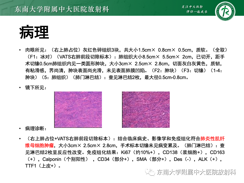 影像PPT - 【PPT】肺硬化性肺细胞瘤-26