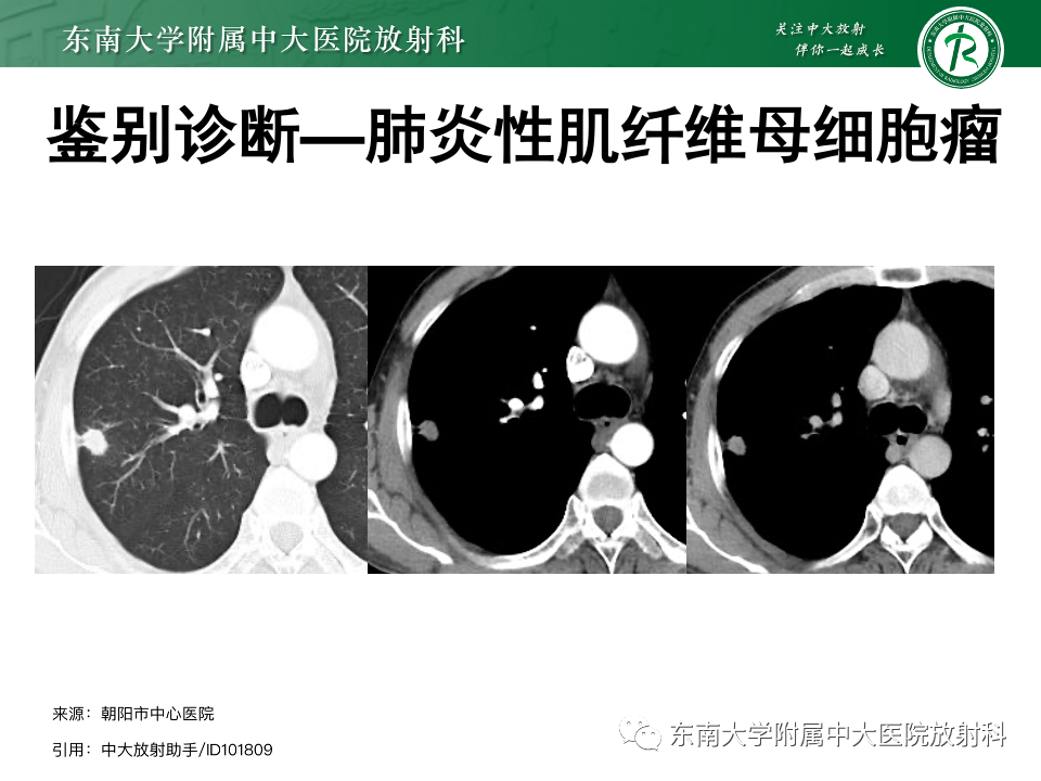 影像PPT - 【PPT】肺硬化性肺细胞瘤-27