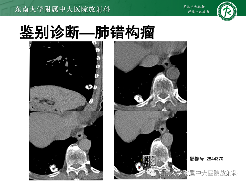影像PPT - 【PPT】肺硬化性肺细胞瘤-29