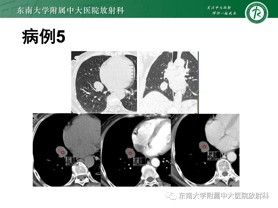 影像PPT - 【PPT】肺硬化性肺细胞瘤-31