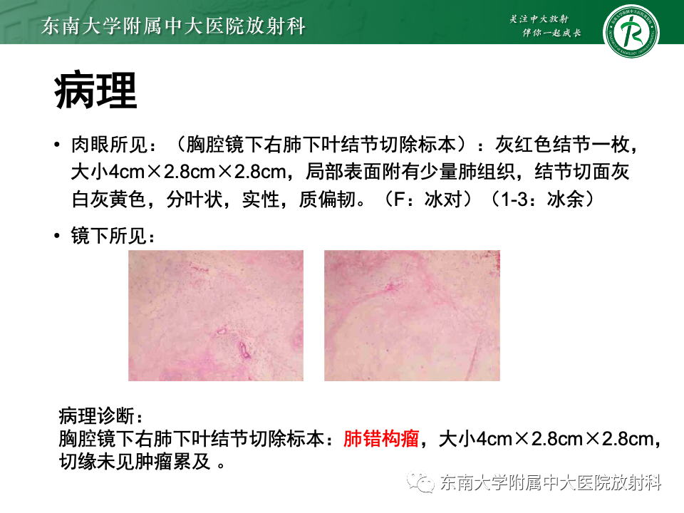影像PPT - 【PPT】肺硬化性肺细胞瘤-32