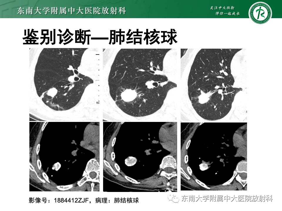 影像PPT - 【PPT】肺硬化性肺细胞瘤-34
