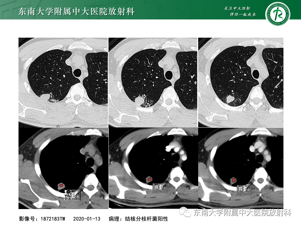 影像PPT - 【PPT】肺硬化性肺细胞瘤-35