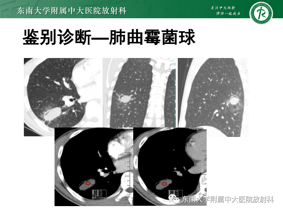 影像PPT - 【PPT】肺硬化性肺细胞瘤-38