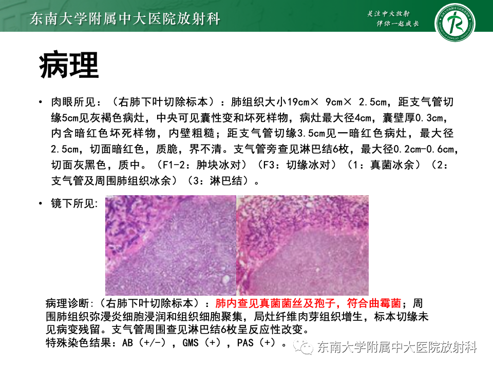 影像PPT - 【PPT】肺硬化性肺细胞瘤-39