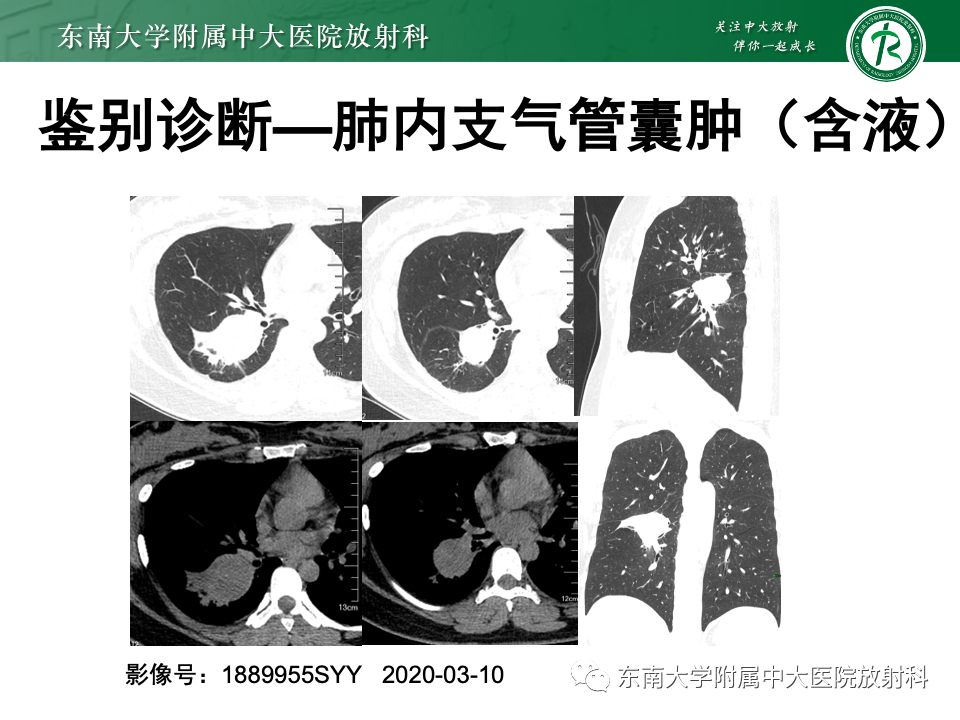 影像PPT - 【PPT】肺硬化性肺细胞瘤-41