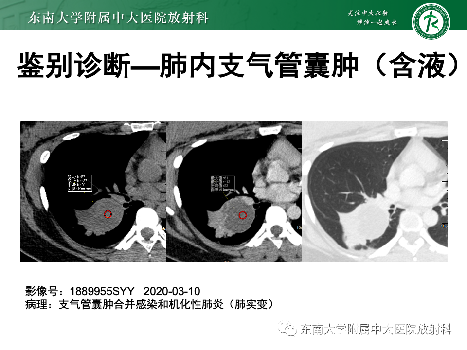 影像PPT - 【PPT】肺硬化性肺细胞瘤-42