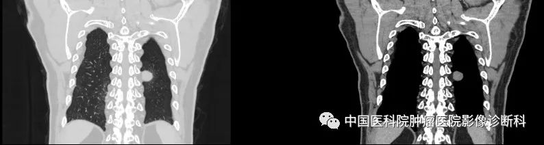 影像PPT - 【病例】胸壁肿物—神经鞘瘤1例CT影像-2