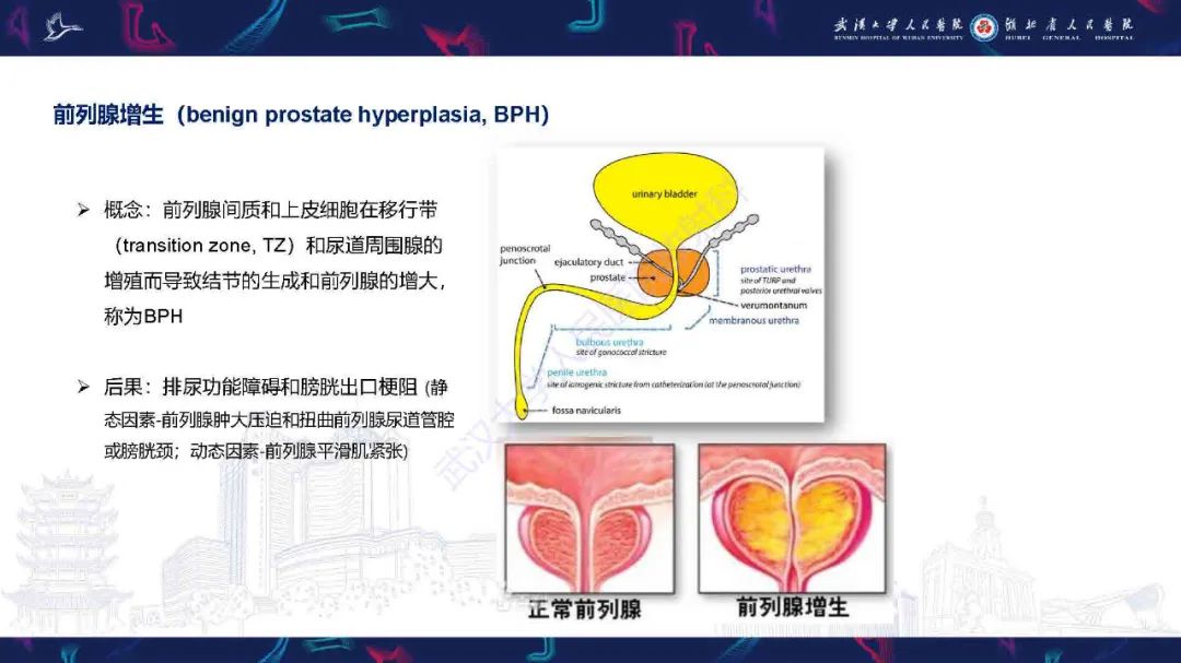 影像PPT - 【PPT】良性前列腺增生治疗前后MRI评估-2
