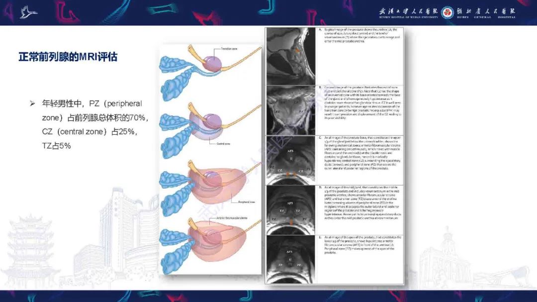 影像PPT - 【PPT】良性前列腺增生治疗前后MRI评估-5