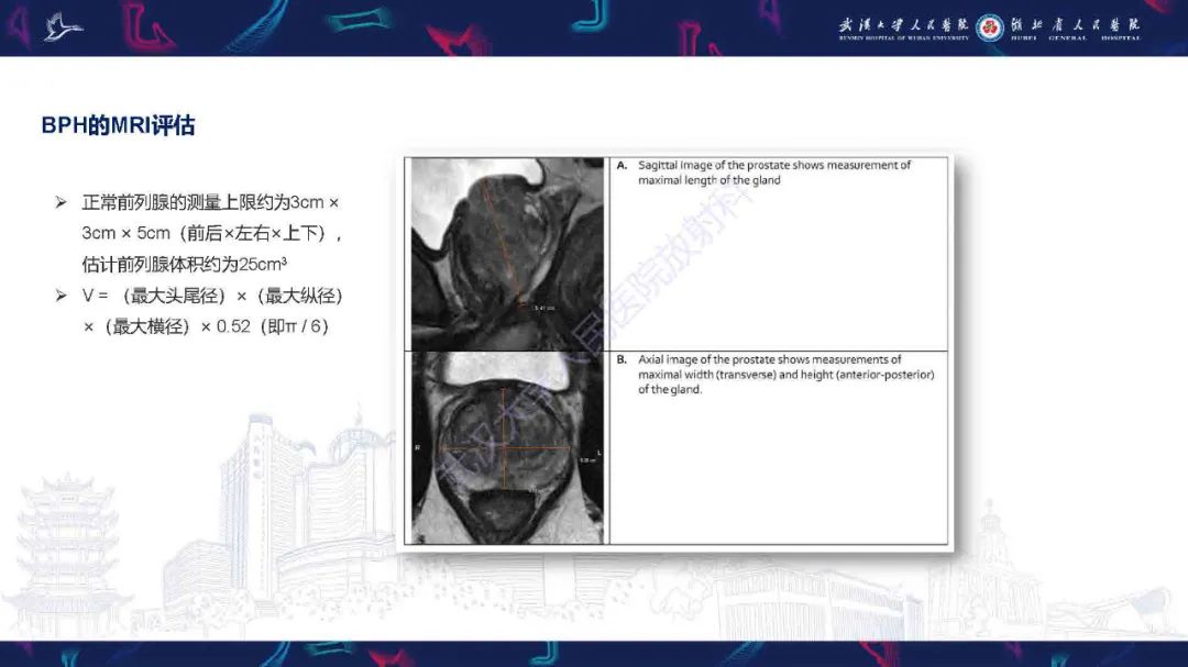 影像PPT - 【PPT】良性前列腺增生治疗前后MRI评估-6