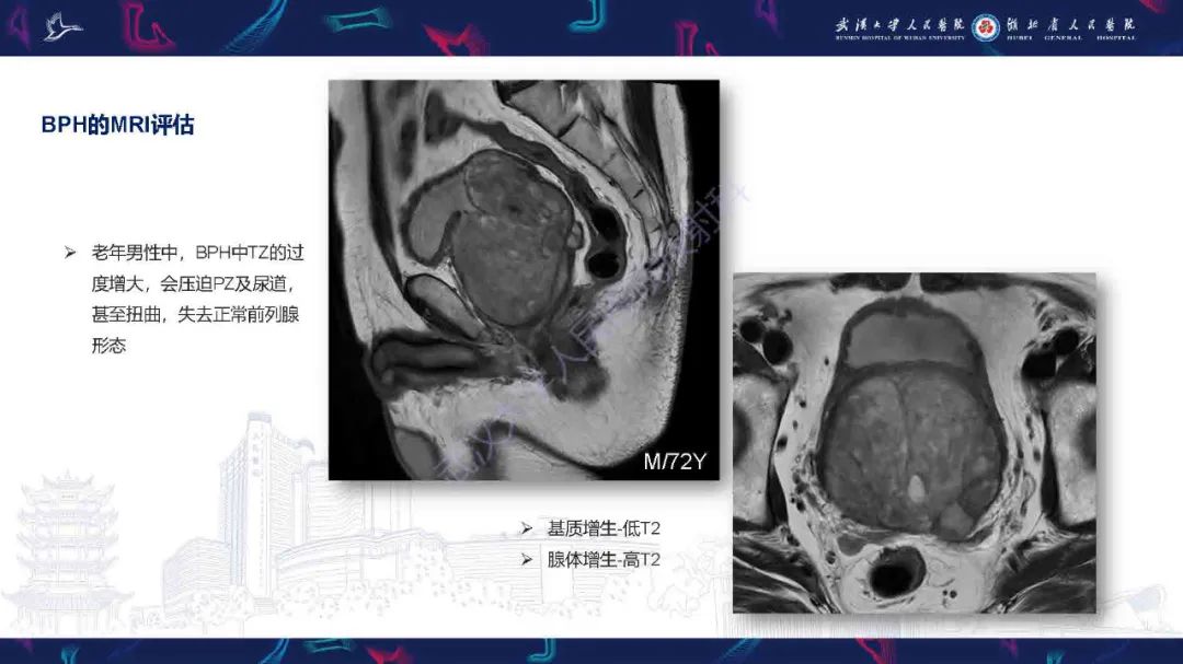 影像PPT - 【PPT】良性前列腺增生治疗前后MRI评估-7