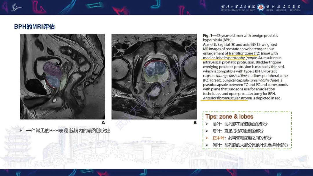 影像PPT - 【PPT】良性前列腺增生治疗前后MRI评估-9