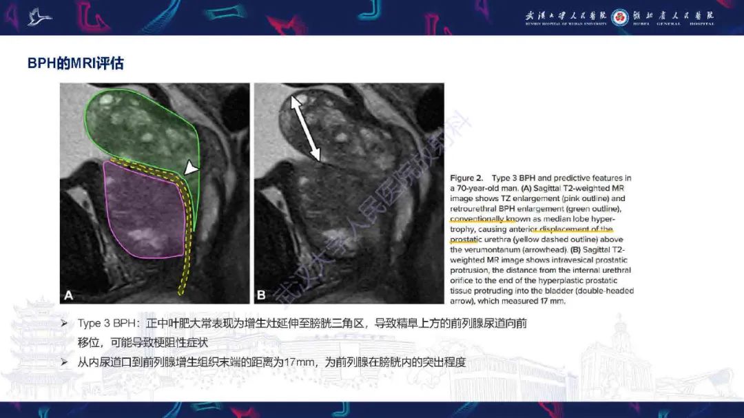 影像PPT - 【PPT】良性前列腺增生治疗前后MRI评估-12