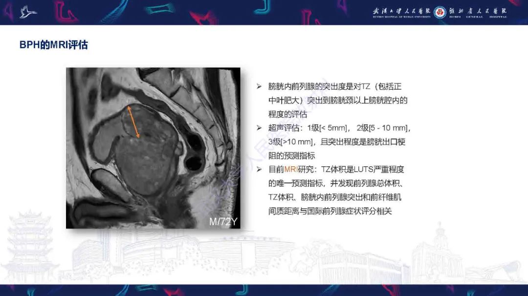 影像PPT - 【PPT】良性前列腺增生治疗前后MRI评估-13