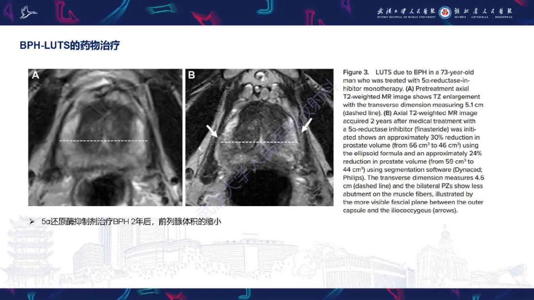 影像PPT - 【PPT】良性前列腺增生治疗前后MRI评估-16