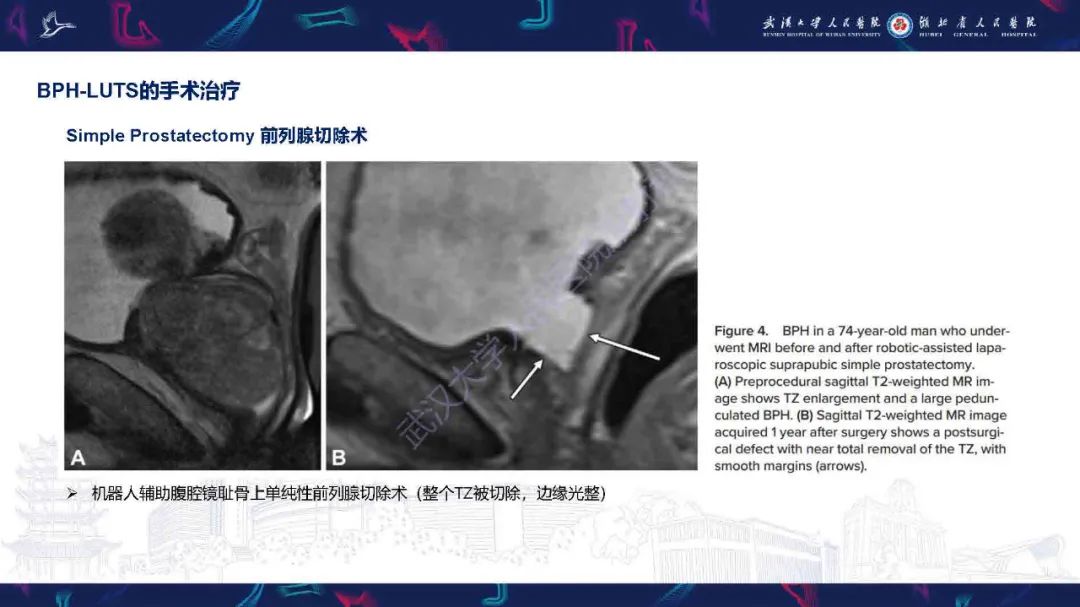 影像PPT - 【PPT】良性前列腺增生治疗前后MRI评估-19