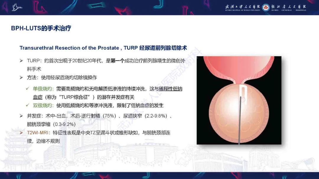 影像PPT - 【PPT】良性前列腺增生治疗前后MRI评估-20