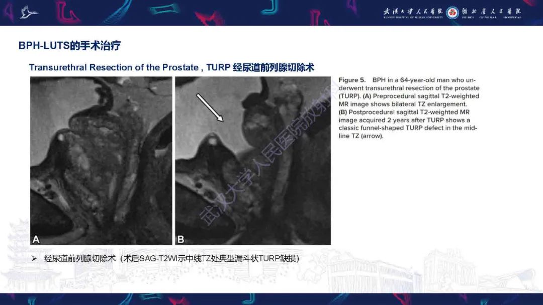 影像PPT - 【PPT】良性前列腺增生治疗前后MRI评估-21