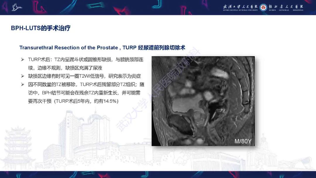 影像PPT - 【PPT】良性前列腺增生治疗前后MRI评估-22