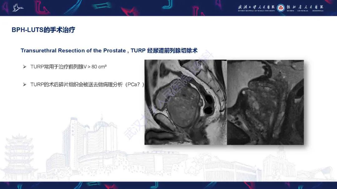 影像PPT - 【PPT】良性前列腺增生治疗前后MRI评估-23