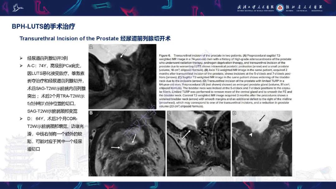 影像PPT - 【PPT】良性前列腺增生治疗前后MRI评估-25