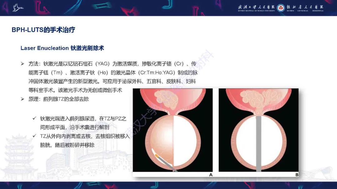 影像PPT - 【PPT】良性前列腺增生治疗前后MRI评估-27