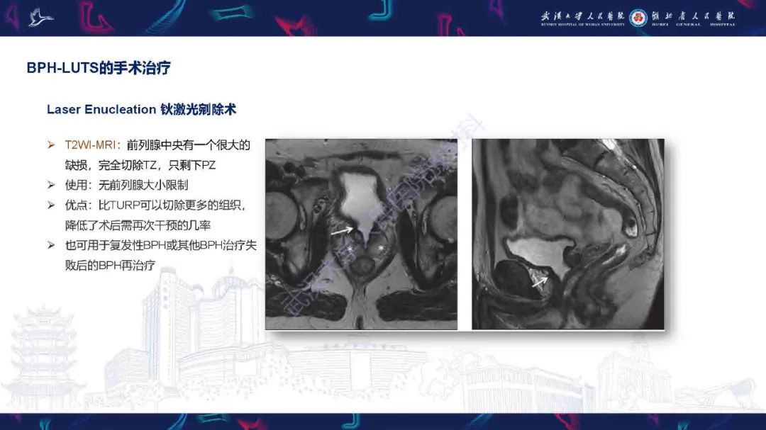 影像PPT - 【PPT】良性前列腺增生治疗前后MRI评估-28
