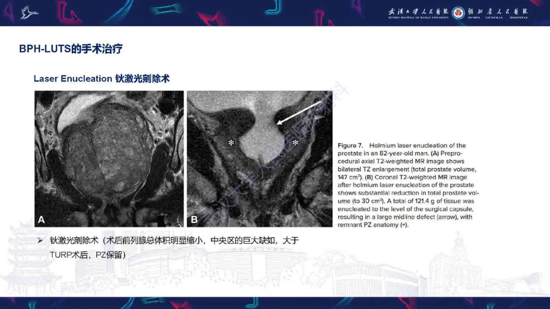 影像PPT - 【PPT】良性前列腺增生治疗前后MRI评估-29