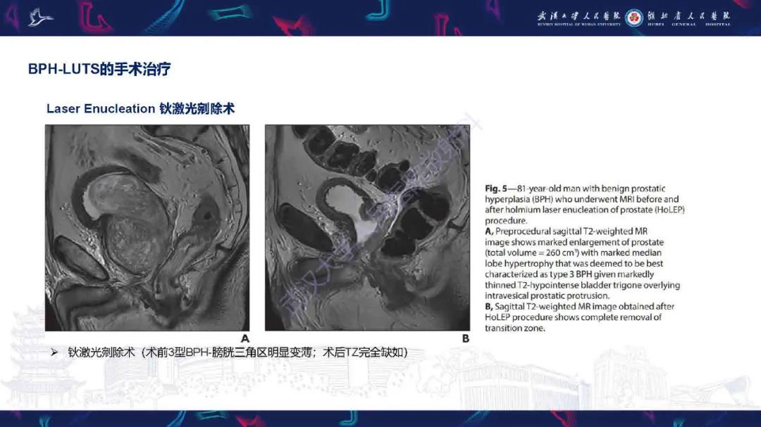 影像PPT - 【PPT】良性前列腺增生治疗前后MRI评估-30