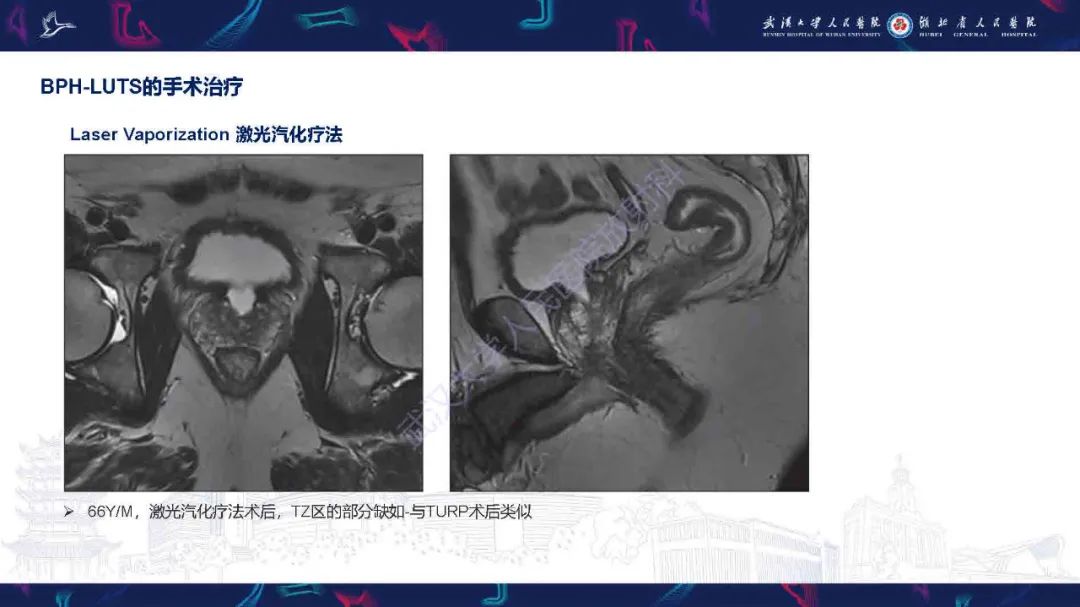 影像PPT - 【PPT】良性前列腺增生治疗前后MRI评估-33