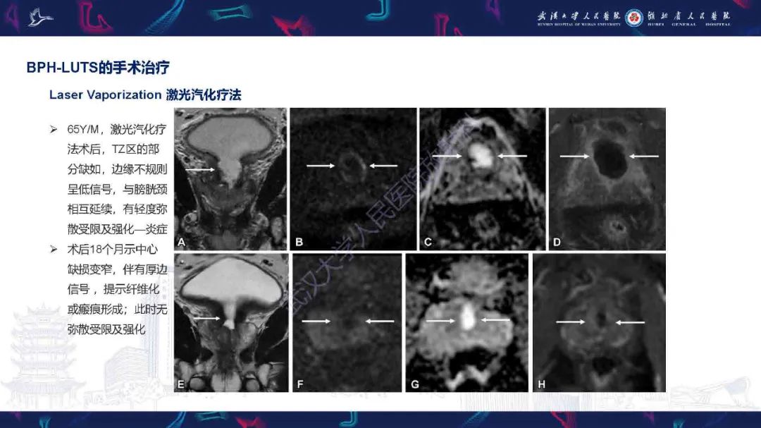 影像PPT - 【PPT】良性前列腺增生治疗前后MRI评估-34