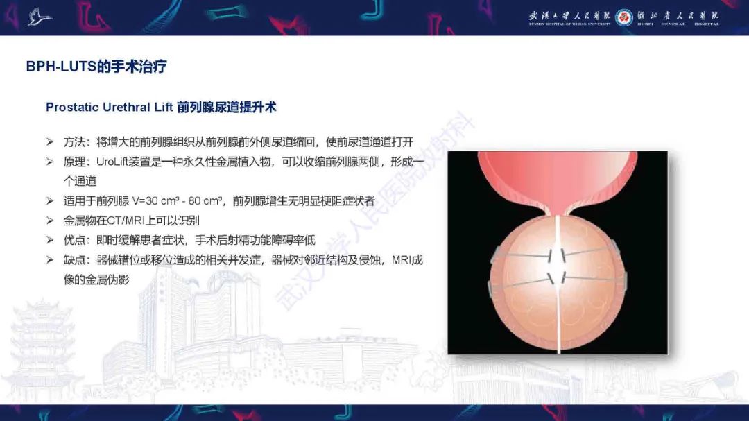 影像PPT - 【PPT】良性前列腺增生治疗前后MRI评估-35